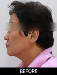 before 이미지