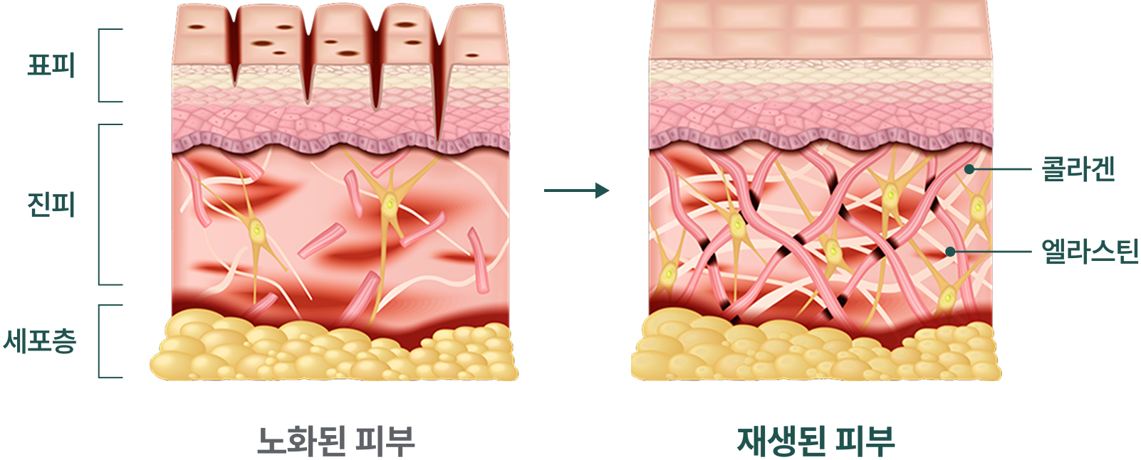 셀스킨주사